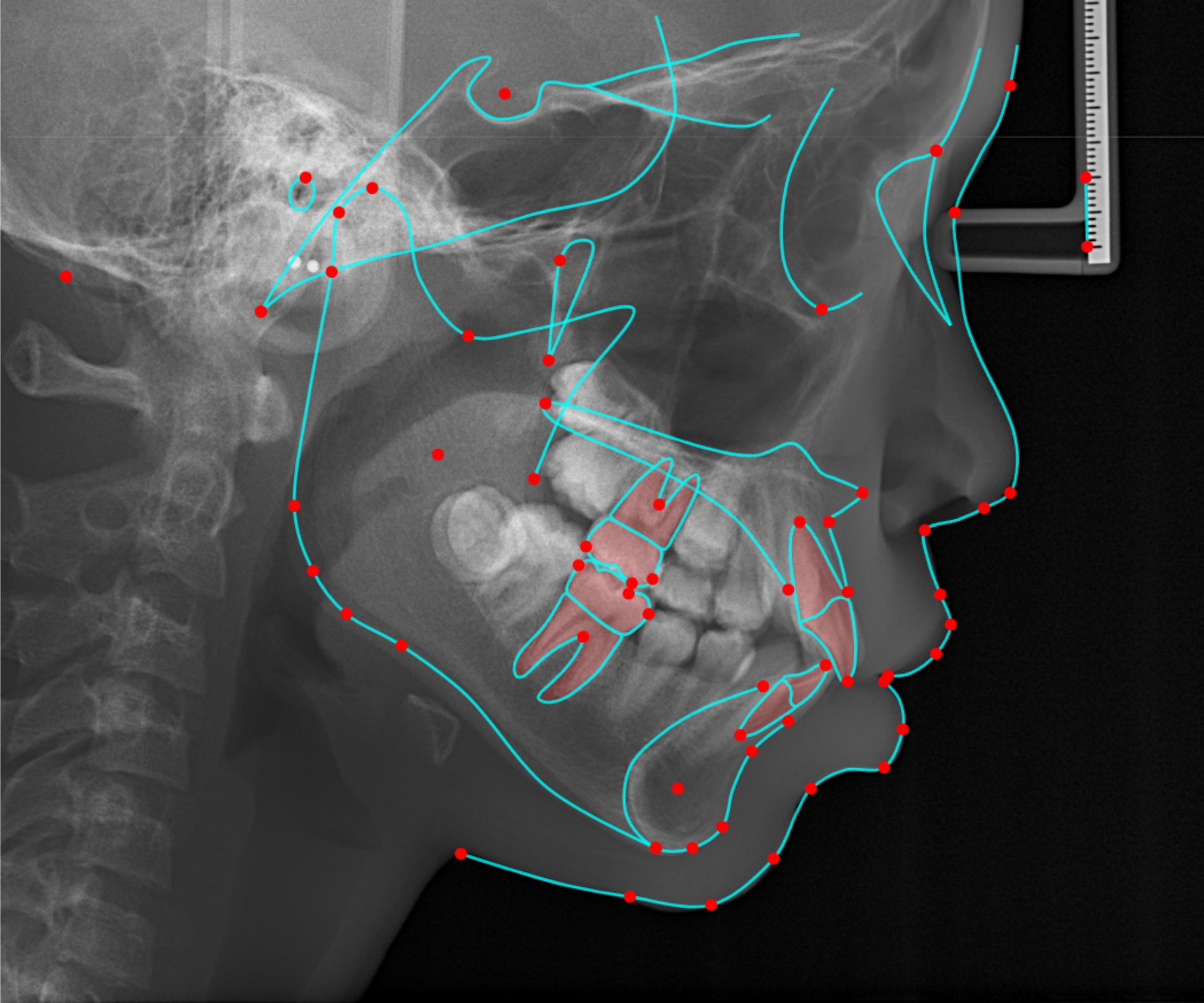Lateral cephalogram with cephalometric tracing