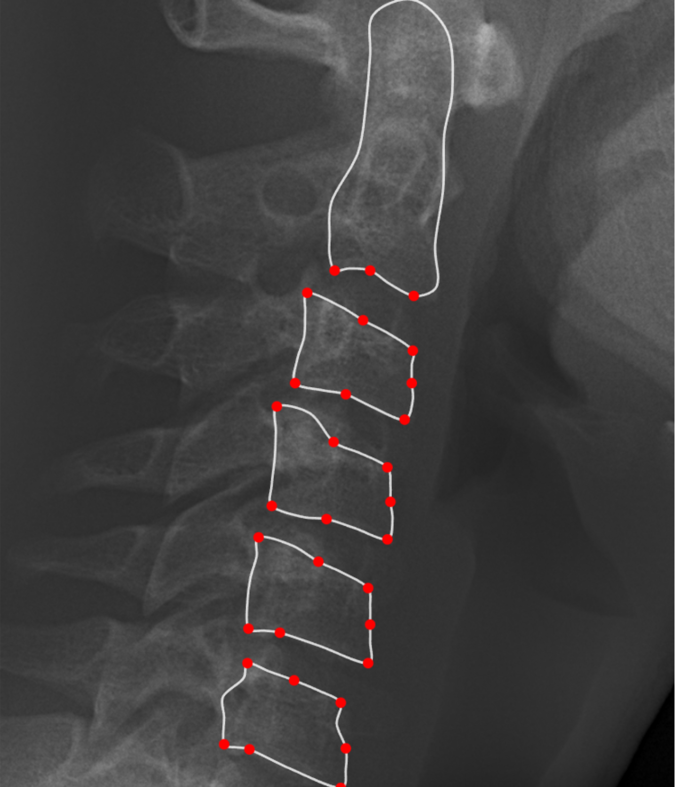 Cervical vertebral maturation analysis