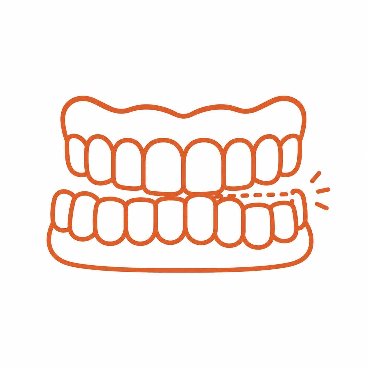 Underbite bite illustration