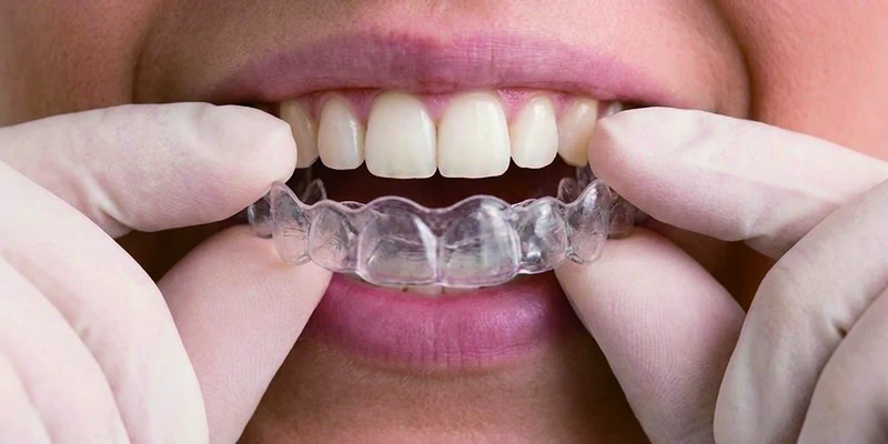 Insert aligners step 2