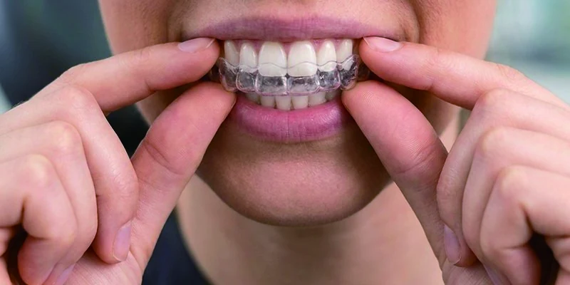 Insert aligners step 3