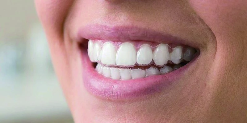 Insert aligners step 4