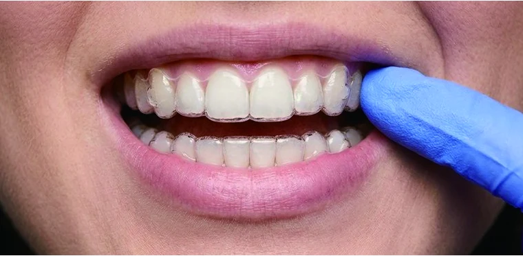 Remove aligners step 1