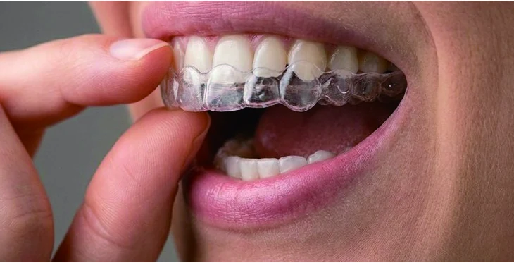 Remove aligners step 2